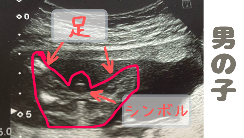 6ヶ月エコーで性別判明!男の子・女の子の見分け方